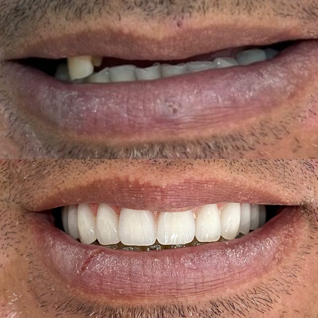 03-ANTES-E-DEPOIS-19.05